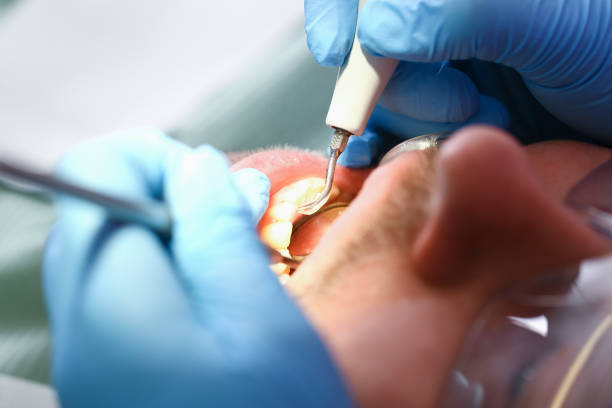 Best Emergency Tooth Extraction in Marengo, IA