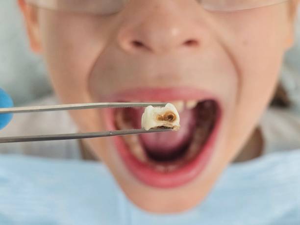 Best Emergency Wisdom Teeth Removal in Marengo, IA